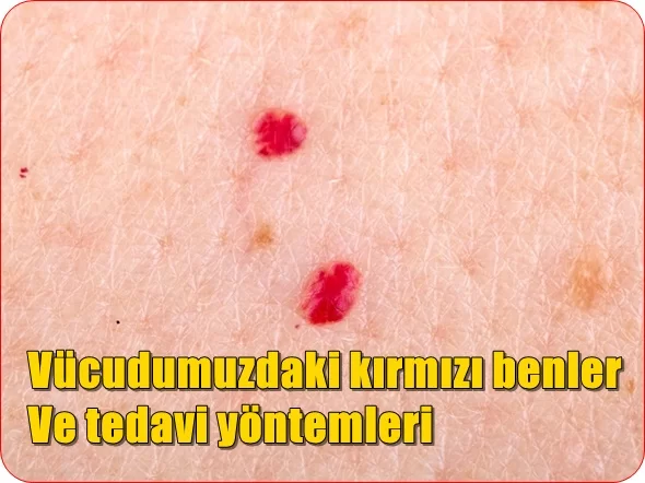 Vücudumuzdaki kırmızı benler ve tedavi yöntemleri